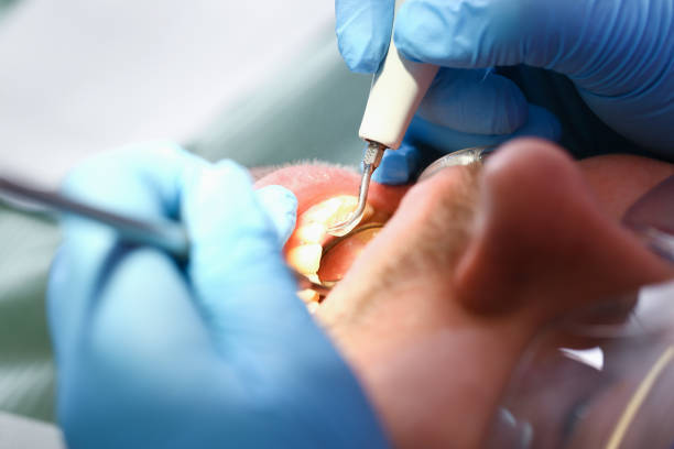 Best Emergency Wisdom Teeth Removal in Lake Shore, WA