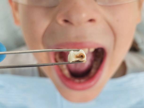 Best Pediatric Emergency Dentist in Lake Shore, WA